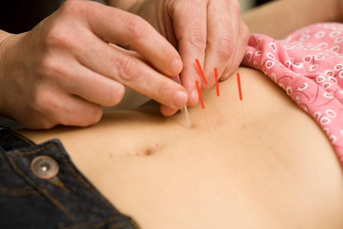 acupuncture-being-applied-to-persons-stomach